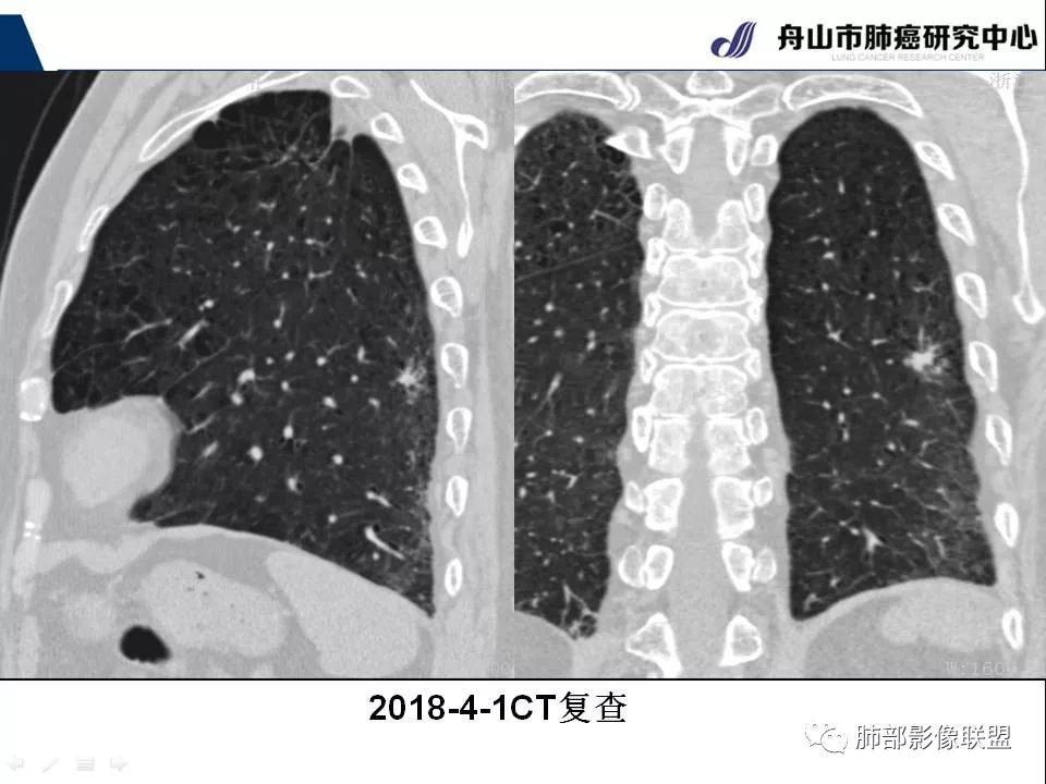 影像PPT - 【PPT】早期肺鳞癌----容易忽视的影像学表现-68