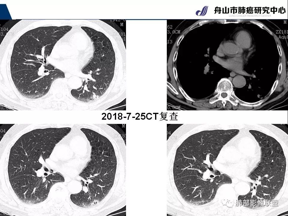 影像PPT - 【PPT】早期肺鳞癌----容易忽视的影像学表现-69