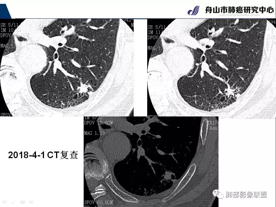 影像PPT - 【PPT】早期肺鳞癌----容易忽视的影像学表现-67