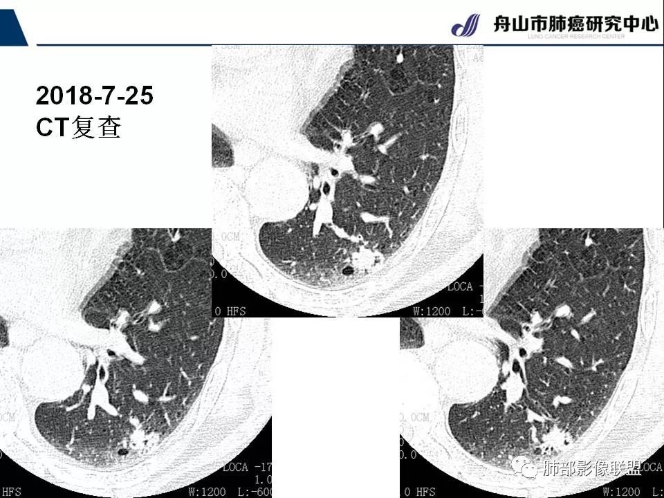 影像PPT - 【PPT】早期肺鳞癌----容易忽视的影像学表现-70
