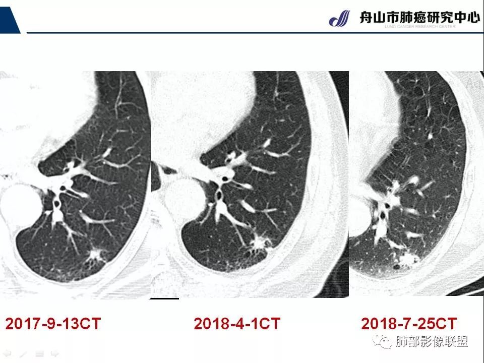 影像PPT - 【PPT】早期肺鳞癌----容易忽视的影像学表现-71