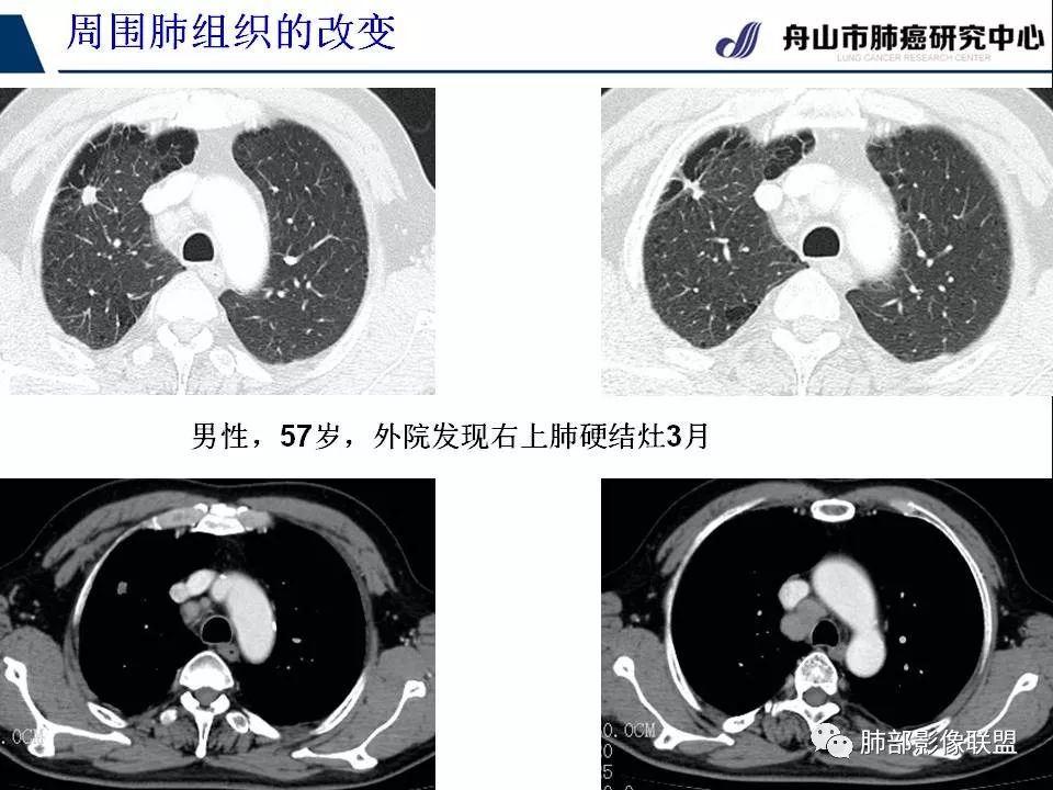影像PPT - 【PPT】早期肺鳞癌----容易忽视的影像学表现-72