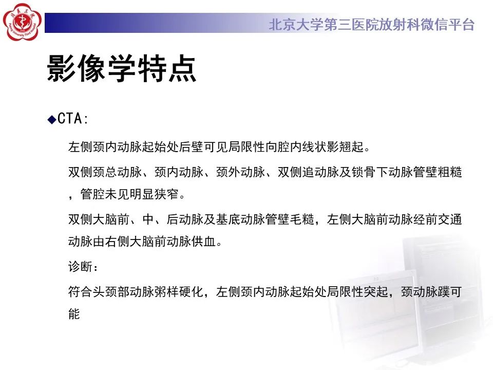 影像PPT - 【PPT】颈动脉蹼-4