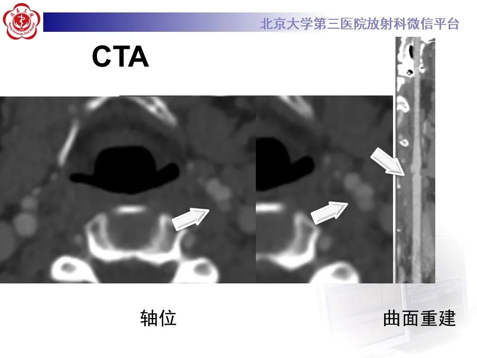 影像PPT - 【PPT】颈动脉蹼-6