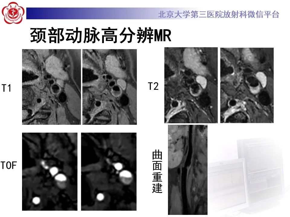 影像PPT - 【PPT】颈动脉蹼-7