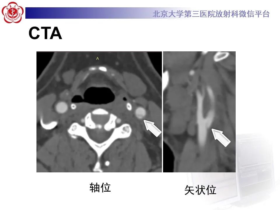 影像PPT - 【PPT】颈动脉蹼-3