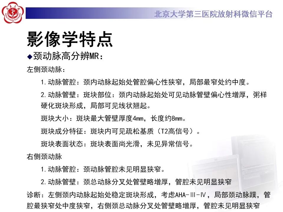 影像PPT - 【PPT】颈动脉蹼-9