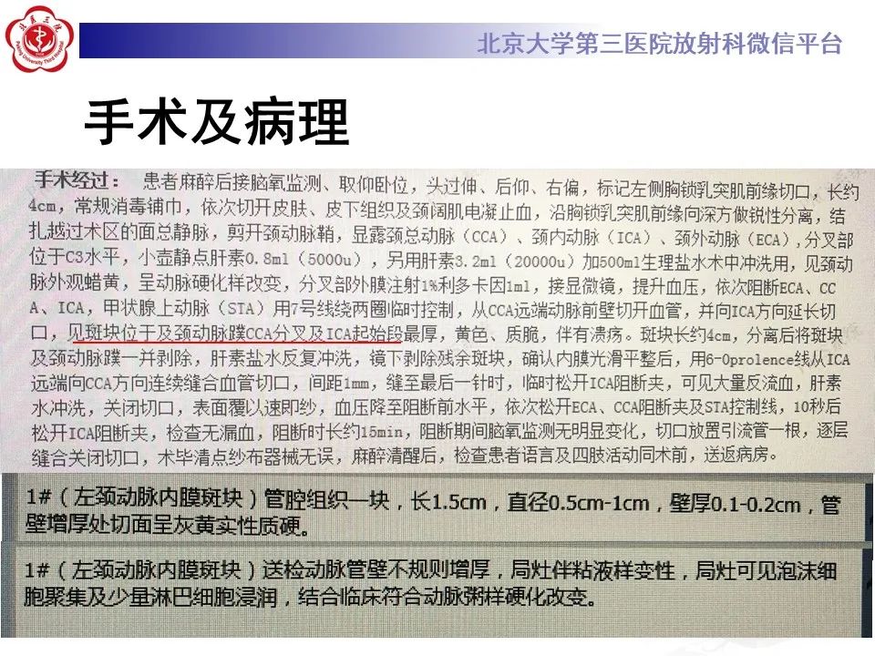 影像PPT - 【PPT】颈动脉蹼-10