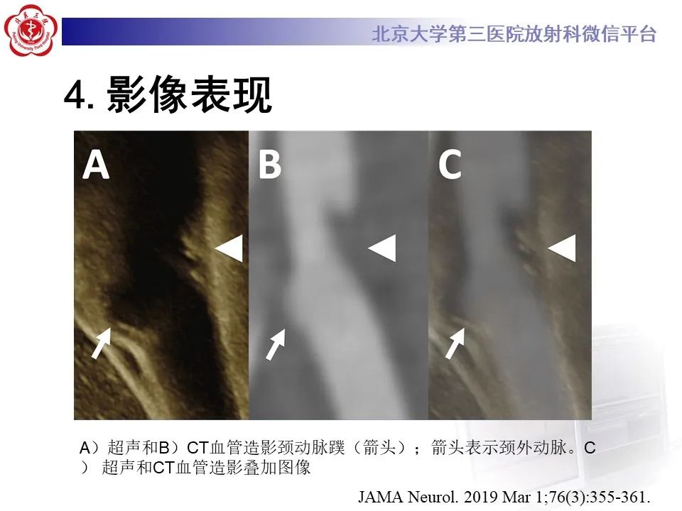 影像PPT - 【PPT】颈动脉蹼-16