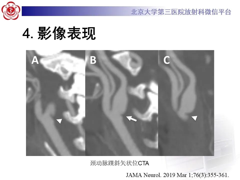 影像PPT - 【PPT】颈动脉蹼-17
