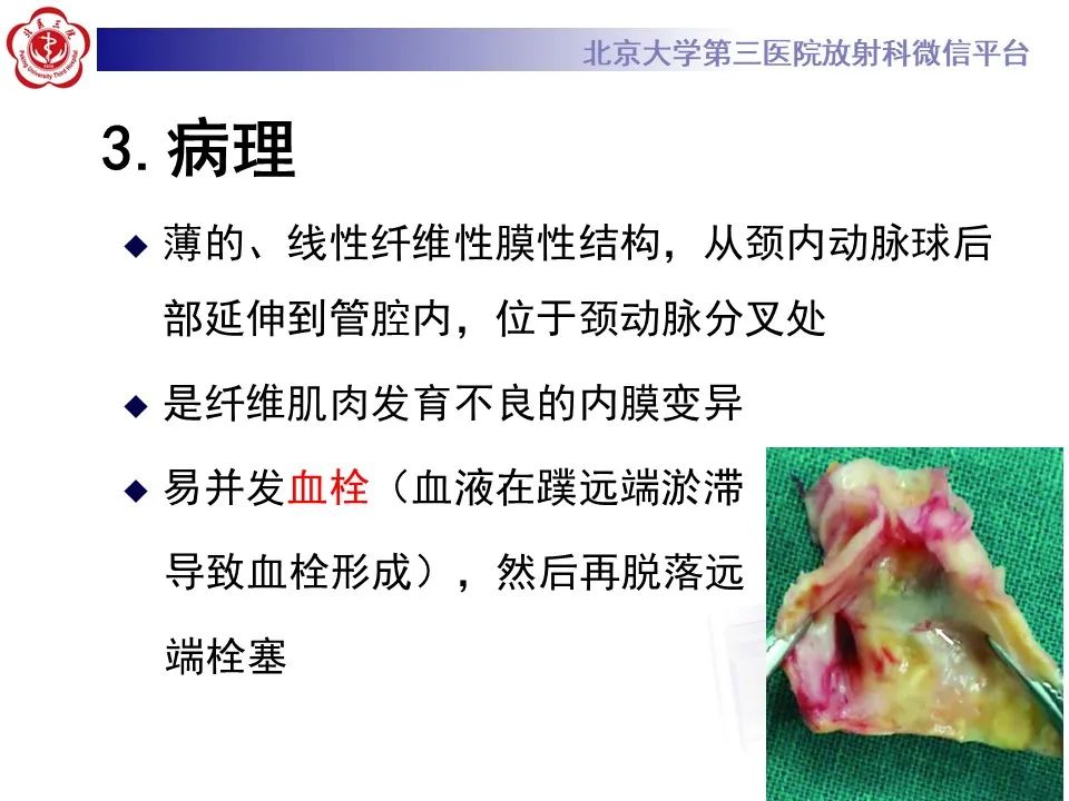 影像PPT - 【PPT】颈动脉蹼-14