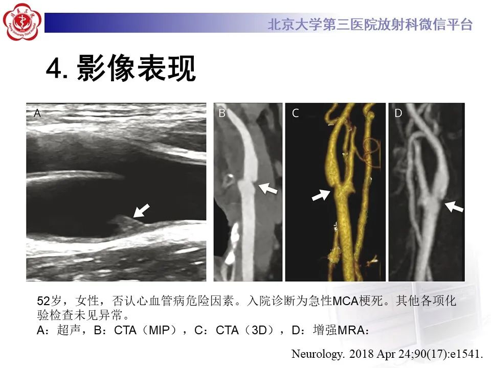 影像PPT - 【PPT】颈动脉蹼-23