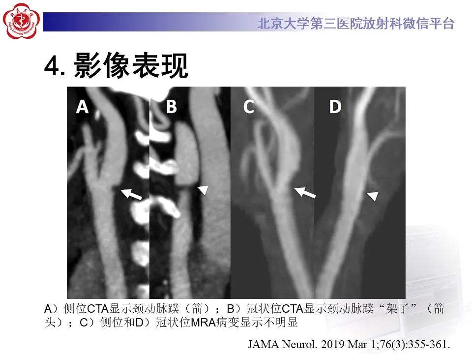 影像PPT - 【PPT】颈动脉蹼-19