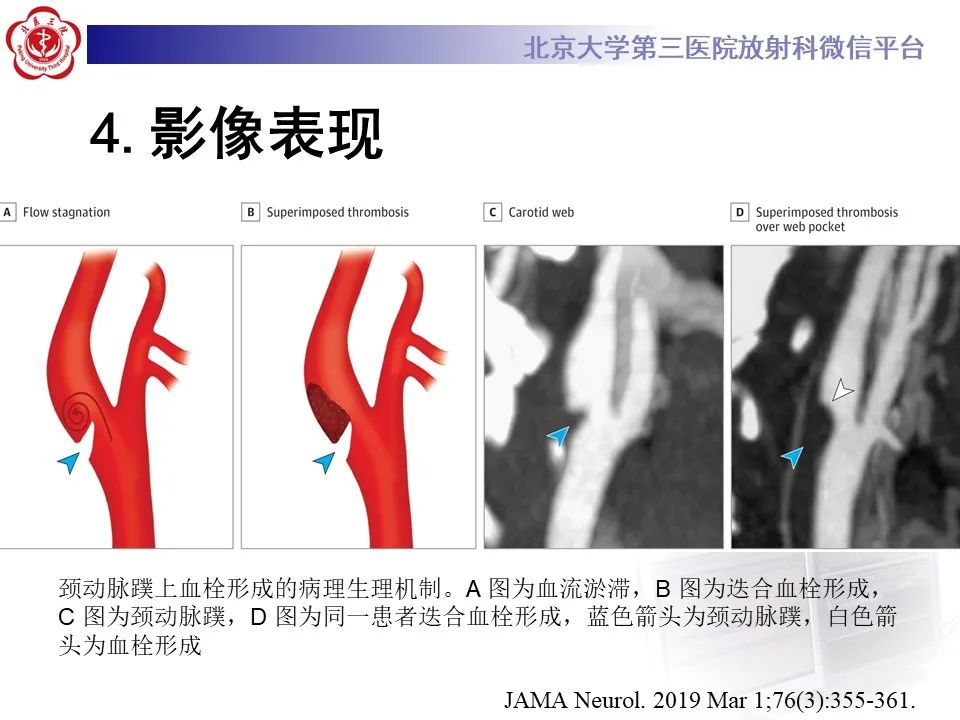 影像PPT - 【PPT】颈动脉蹼-18