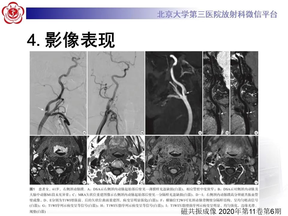 影像PPT - 【PPT】颈动脉蹼-20