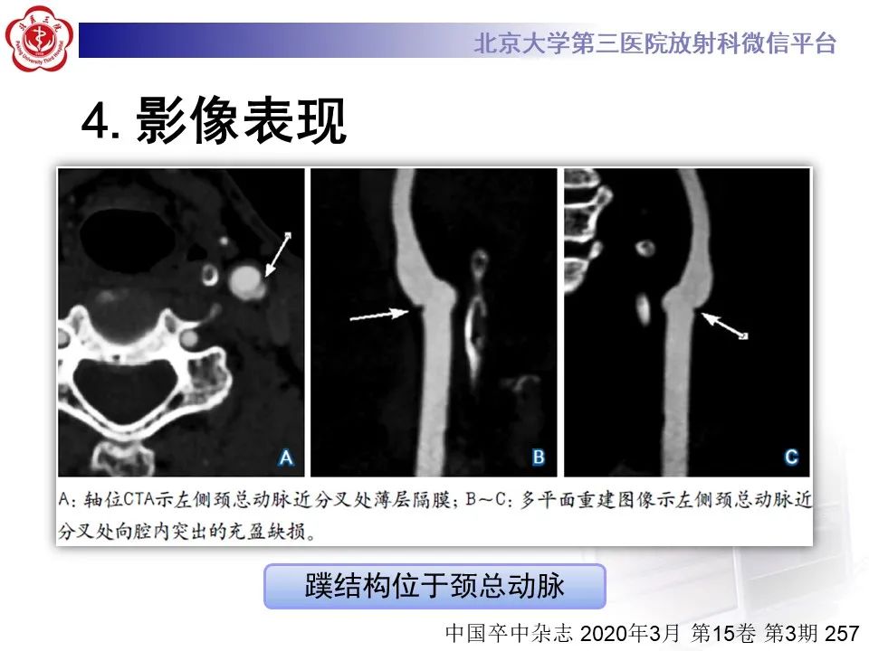 影像PPT - 【PPT】颈动脉蹼-24