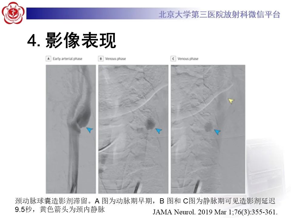 影像PPT - 【PPT】颈动脉蹼-22