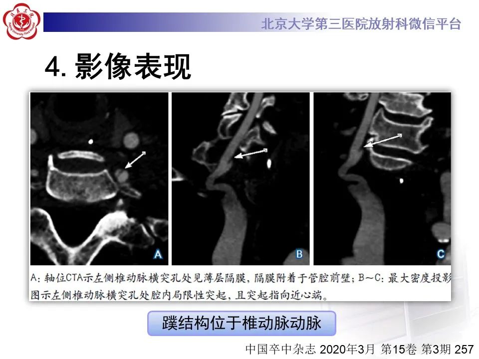 影像PPT - 【PPT】颈动脉蹼-26