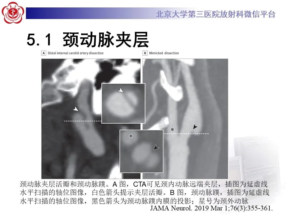 影像PPT - 【PPT】颈动脉蹼-30