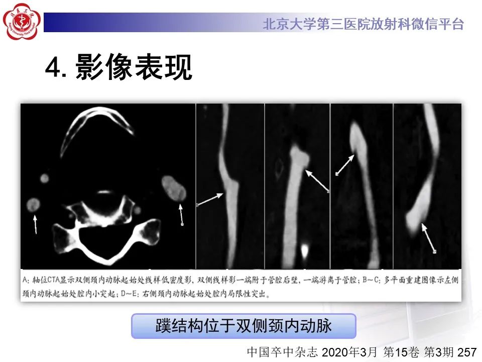 影像PPT - 【PPT】颈动脉蹼-27
