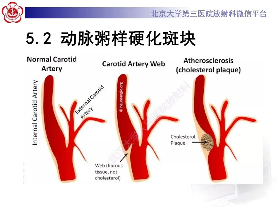 影像PPT - 【PPT】颈动脉蹼-32