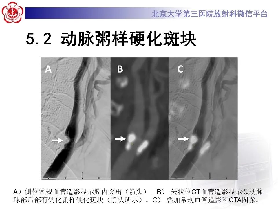 影像PPT - 【PPT】颈动脉蹼-33