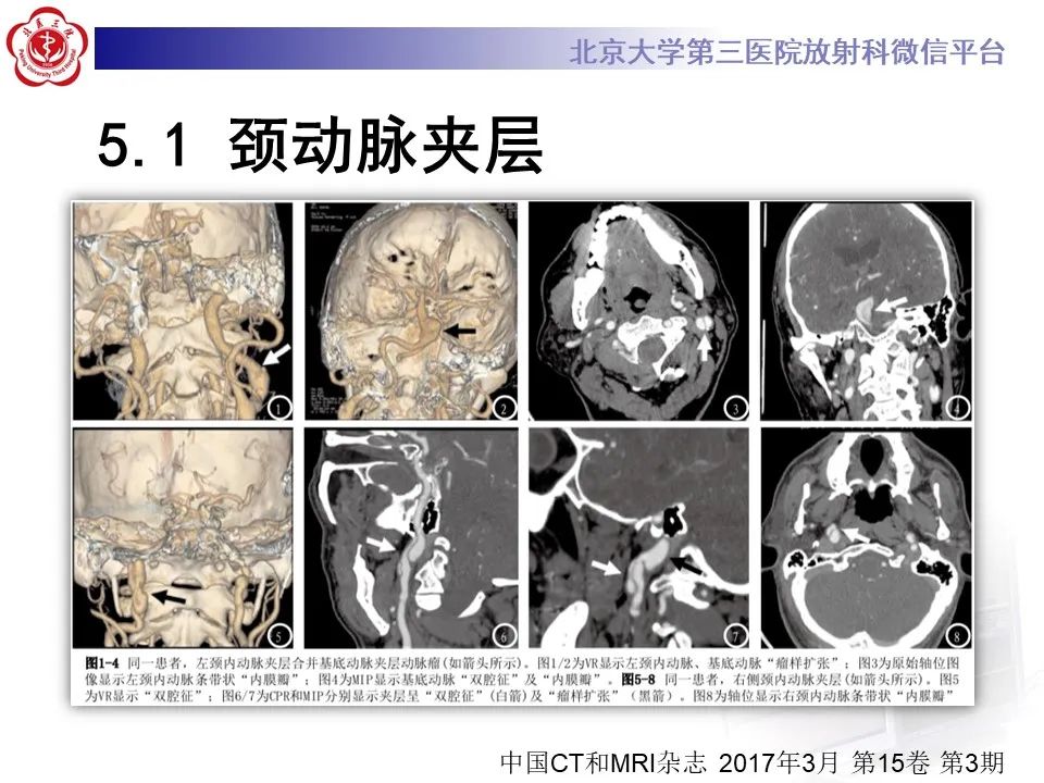 影像PPT - 【PPT】颈动脉蹼-31