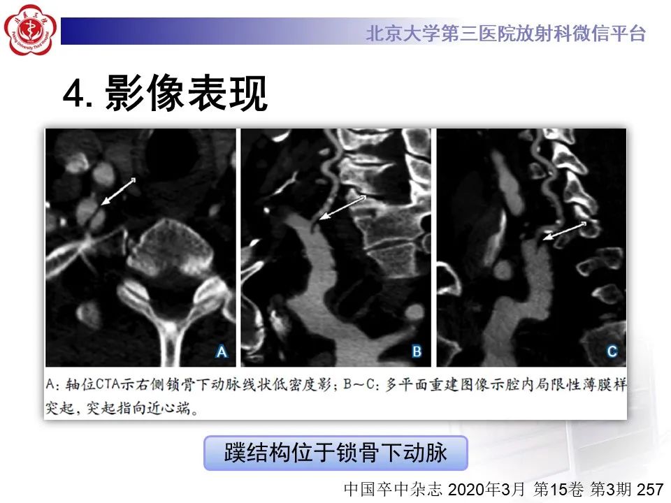 影像PPT - 【PPT】颈动脉蹼-1