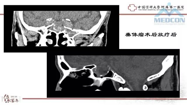 影像PPT - 【PPT】鞍区肿瘤性病变的影像诊断思路-4
