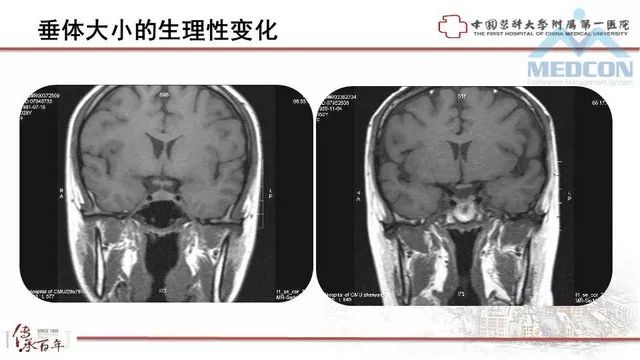 影像PPT - 【PPT】鞍区肿瘤性病变的影像诊断思路-3