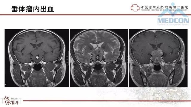 影像PPT - 【PPT】鞍区肿瘤性病变的影像诊断思路-14