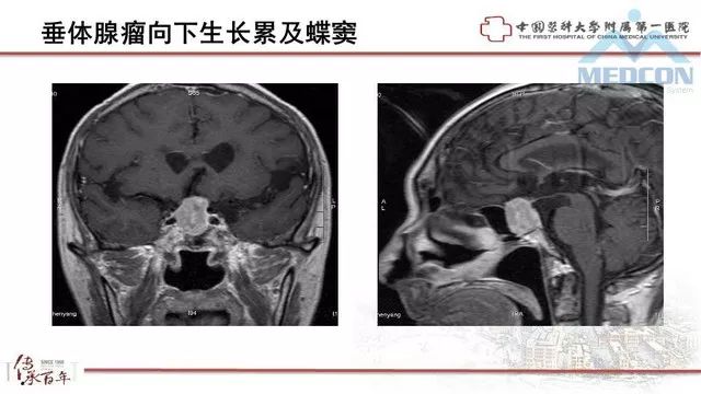 影像PPT - 【PPT】鞍区肿瘤性病变的影像诊断思路-16
