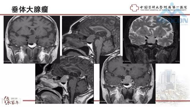 影像PPT - 【PPT】鞍区肿瘤性病变的影像诊断思路-13