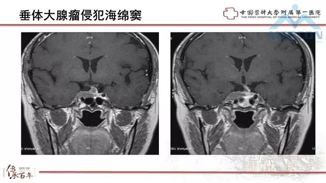 影像PPT - 【PPT】鞍区肿瘤性病变的影像诊断思路-15