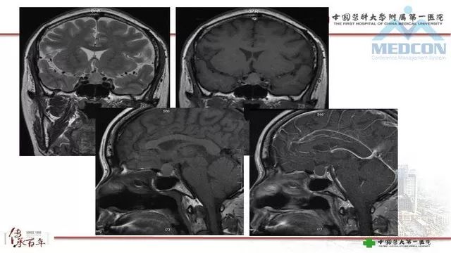 影像PPT - 【PPT】鞍区肿瘤性病变的影像诊断思路-18
