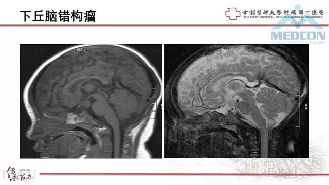 影像PPT - 【PPT】鞍区肿瘤性病变的影像诊断思路-22