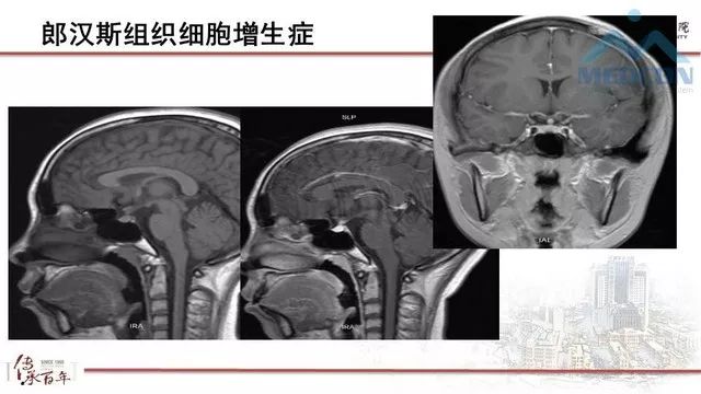 影像PPT - 【PPT】鞍区肿瘤性病变的影像诊断思路-23