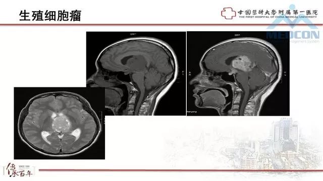 影像PPT - 【PPT】鞍区肿瘤性病变的影像诊断思路-24