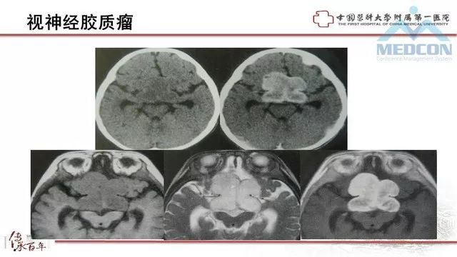 影像PPT - 【PPT】鞍区肿瘤性病变的影像诊断思路-26