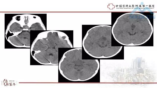 影像PPT - 【PPT】鞍区肿瘤性病变的影像诊断思路-27