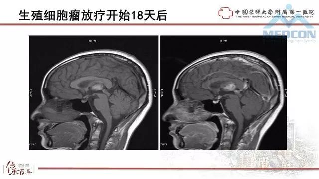 影像PPT - 【PPT】鞍区肿瘤性病变的影像诊断思路-25