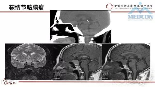 影像PPT - 【PPT】鞍区肿瘤性病变的影像诊断思路-30