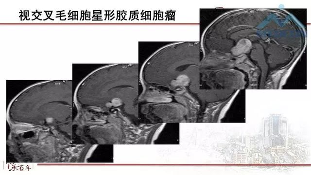 影像PPT - 【PPT】鞍区肿瘤性病变的影像诊断思路-29