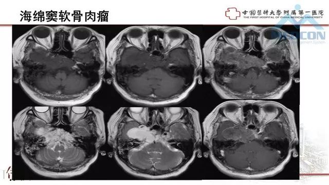 影像PPT - 【PPT】鞍区肿瘤性病变的影像诊断思路-40