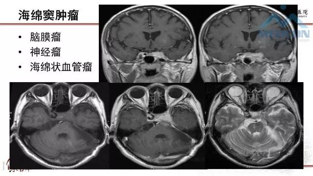 影像PPT - 【PPT】鞍区肿瘤性病变的影像诊断思路-37