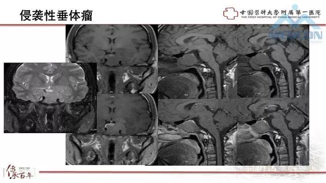 影像PPT - 【PPT】鞍区肿瘤性病变的影像诊断思路-44