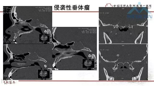 影像PPT - 【PPT】鞍区肿瘤性病变的影像诊断思路-43
