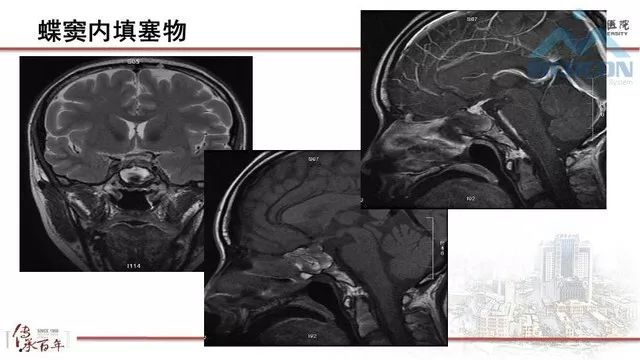 影像PPT - 【PPT】鞍区肿瘤性病变的影像诊断思路-45