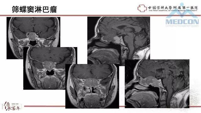 影像PPT - 【PPT】鞍区肿瘤性病变的影像诊断思路-48