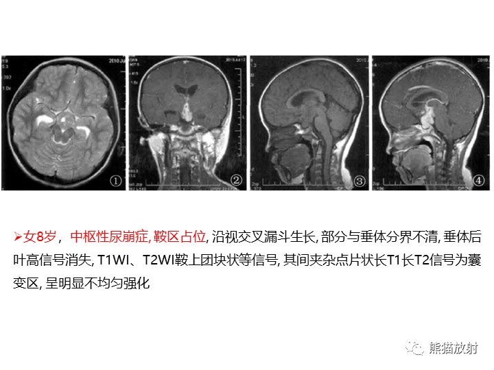 影像PPT - 【病例】颅内生殖细胞瘤2例MR-28